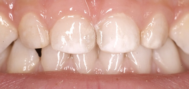 Como lidar com manchas brancas nos dentes