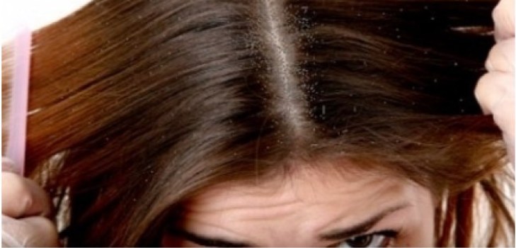 cabelo com caspa