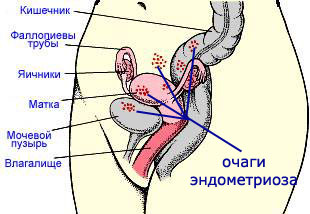 Endometriose: tratamento com remédios populares