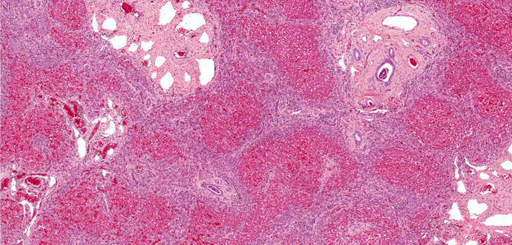 O que é fibrose? Sintomas, fotos, tratamento