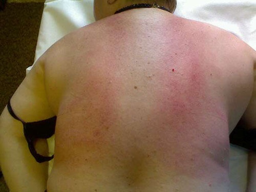 Devem ocorrer hematomas após a massagem