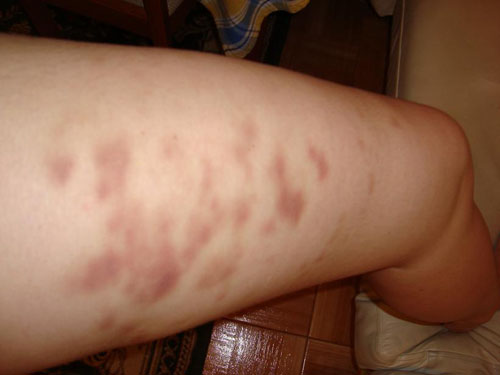 Devem ocorrer hematomas após a massagem