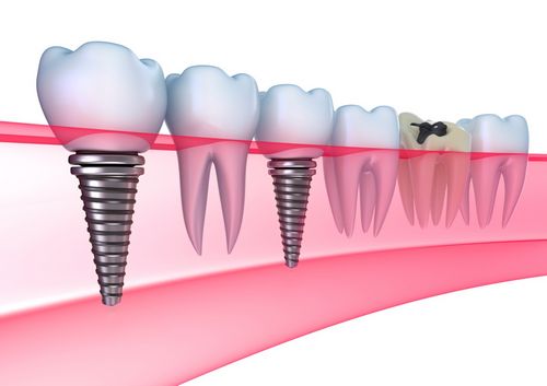 A implantação dentária é um luxo ou uma necessidade? 