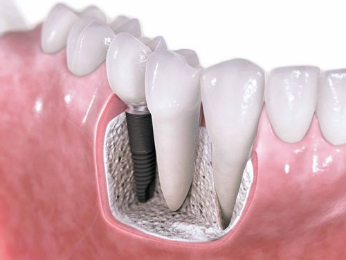 A implantação dentária é um luxo ou uma necessidade? 