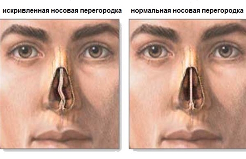 Como tratar a curvatura do septo nasal: cirurgia, correção laser