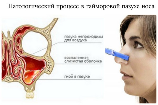Brown Snot: por que é importante começar o tratamento a tempo