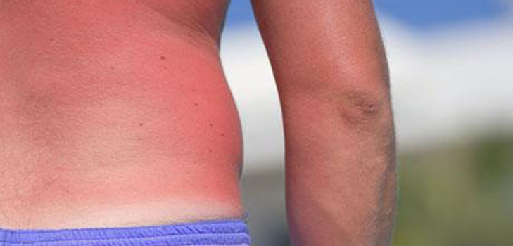A pele é queimada ao sol. O que devo fazer? Receitas, máscaras, dicas