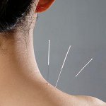 Tratamento com acupuntura Tratamento com acupuntura