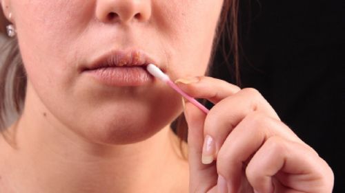 Formas eficazes de tratar resfriados nos lábios