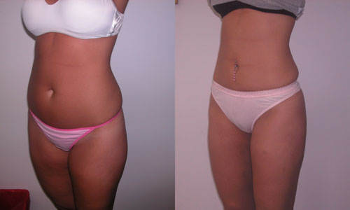 Lipoaspiração do abdômen e coxas: comentários, fotos antes e depois