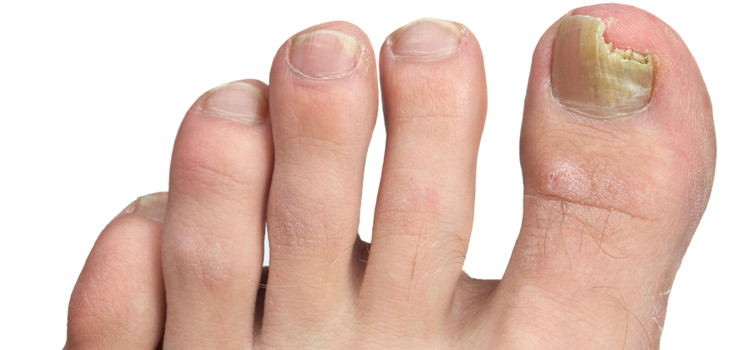 Os melhores remédios para o fungo das unhas nas pernas e nas mãos