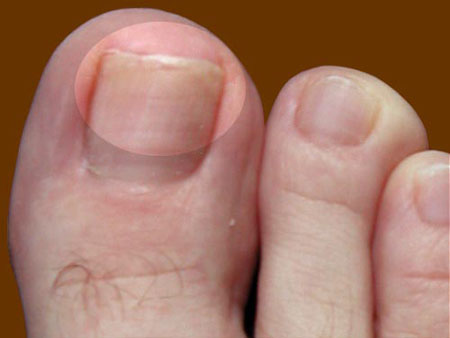 Os melhores remédios para o fungo das unhas nas pernas e nas mãos