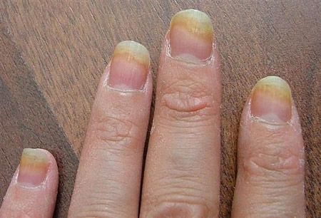 Os melhores remédios para o fungo das unhas nas pernas e nas mãos