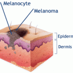 Melanoma da pele