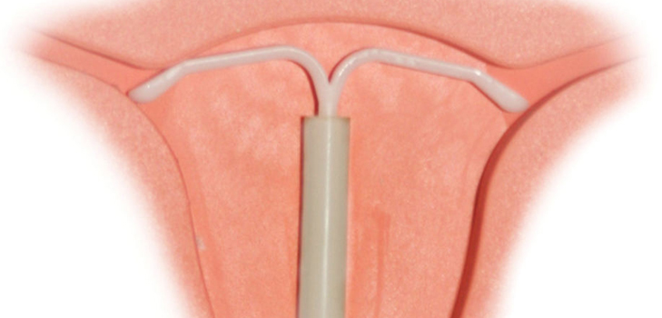 É possível colocar um dispositivo intra-uterino para mulheres nulíparas
