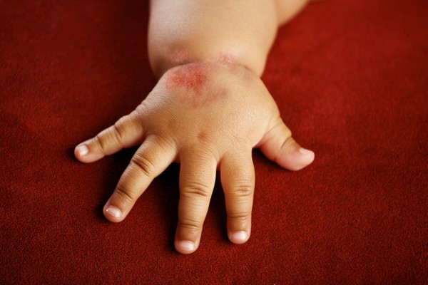 Bolhas aquosas apareceram nas palmas das mãos: o que fazer