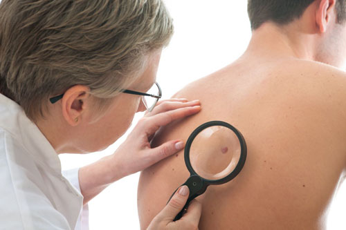 Marcas de nascentes no corpo e seus perigos