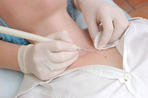 Marcas de nascentes no corpo e seus perigos